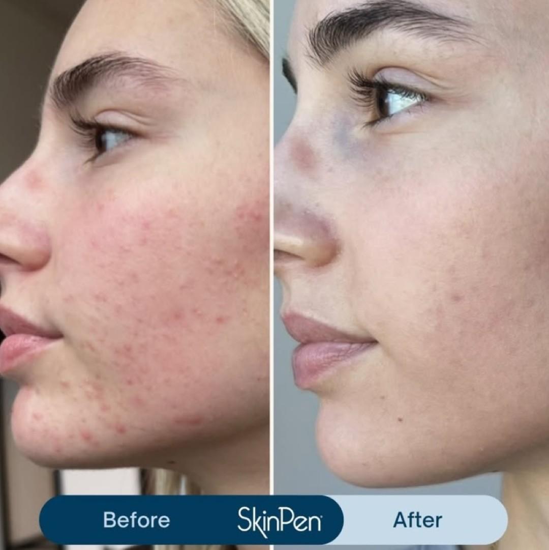 SkinPen microneedling resultaat