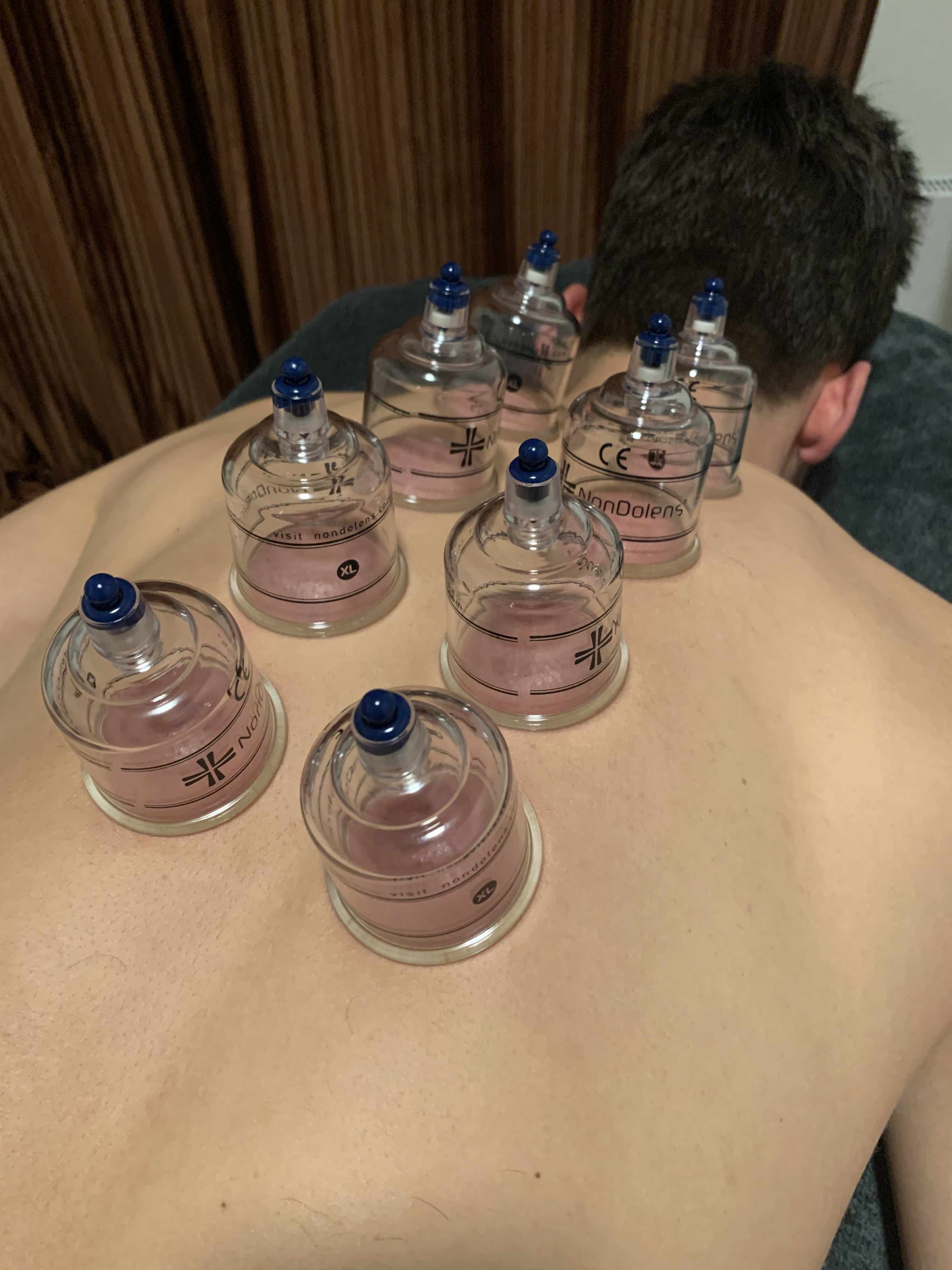 cupping